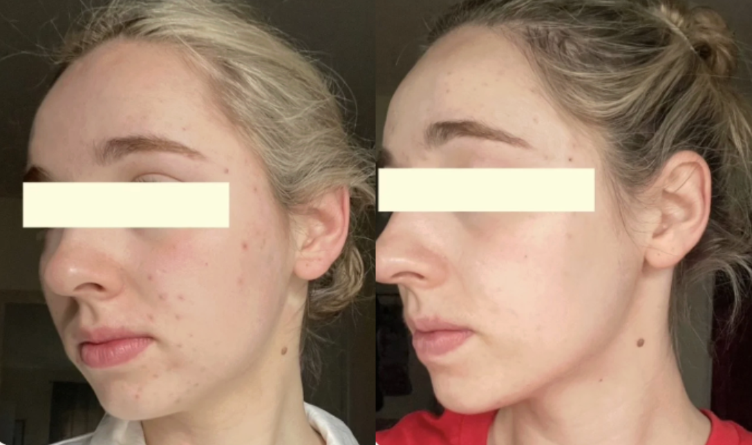 Root cause acne specialist and naturopathic doctor offering virtual 1:1 sessions and functional lab testing to uncover hormonal, gut, and lifestyle imbalances driving acne. Clear your skin from the inside out with personalized, holistic care.
