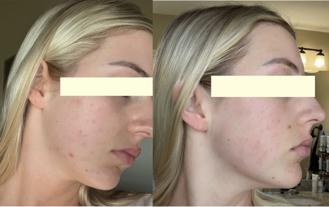 Root cause acne specialist and naturopathic doctor offering virtual 1:1 sessions and functional lab testing to uncover hormonal, gut, and lifestyle imbalances driving acne. Clear your skin from the inside out with personalized, holistic care.
