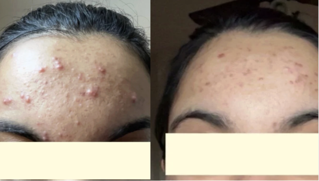 Root cause acne specialist and naturopathic doctor offering virtual 1:1 sessions and functional lab testing to uncover hormonal, gut, and lifestyle imbalances driving acne. Clear your skin from the inside out with personalized, holistic care.