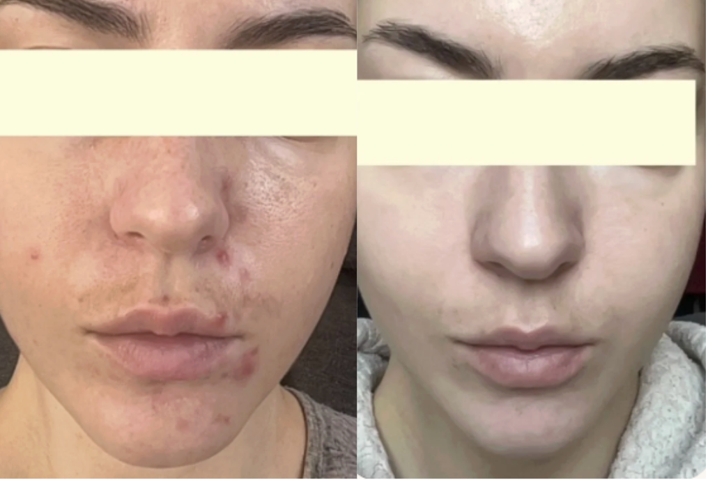Root cause acne specialist and naturopathic doctor offering virtual 1:1 sessions and functional lab testing to uncover hormonal, gut, and lifestyle imbalances driving acne. Clear your skin from the inside out with personalized, holistic care.