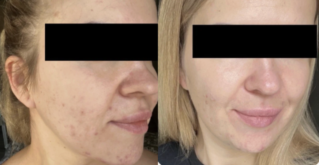 Root cause acne specialist and naturopathic doctor offering virtual 1:1 sessions and functional lab testing to uncover hormonal, gut, and lifestyle imbalances driving acne. Clear your skin from the inside out with personalized, holistic care.