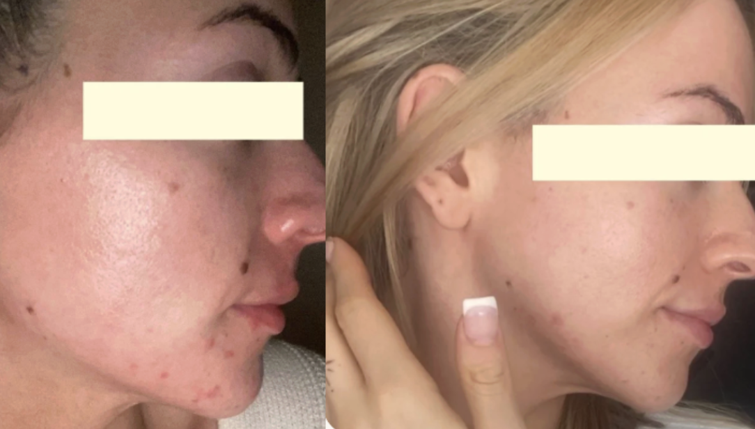 Root cause acne specialist and naturopathic doctor offering virtual 1:1 sessions and functional lab testing to uncover hormonal, gut, and lifestyle imbalances driving acne. Clear your skin from the inside out with personalized, holistic care.