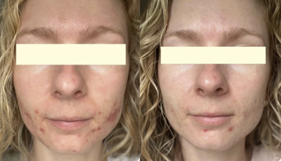 Root cause acne specialist and naturopathic doctor offering virtual 1:1 sessions and functional lab testing to uncover hormonal, gut, and lifestyle imbalances driving acne. Clear your skin from the inside out with personalized, holistic care.