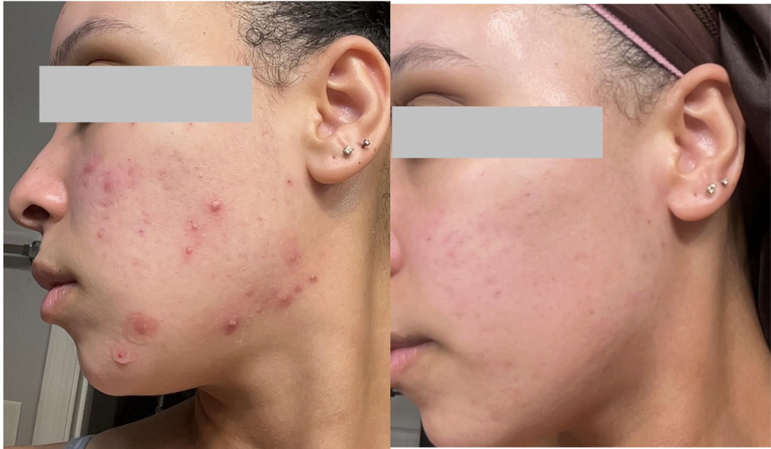 Root cause acne specialist and naturopathic doctor offering virtual 1:1 sessions and functional lab testing to uncover hormonal, gut, and lifestyle imbalances driving acne. Clear your skin from the inside out with personalized, holistic care.