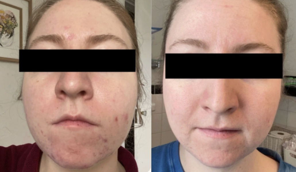 Root cause acne specialist and naturopathic doctor offering virtual 1:1 sessions and functional lab testing to uncover hormonal, gut, and lifestyle imbalances driving acne. Clear your skin from the inside out with personalized, holistic care.