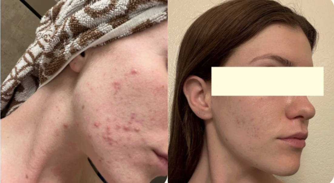 Root cause acne specialist and naturopathic doctor offering virtual 1:1 sessions and functional lab testing to uncover hormonal, gut, and lifestyle imbalances driving acne. Clear your skin from the inside out with personalized, holistic care.