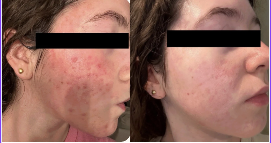 Root cause acne specialist and naturopathic doctor offering virtual 1:1 sessions and functional lab testing to uncover hormonal, gut, and lifestyle imbalances driving acne. Clear your skin from the inside out with personalized, holistic care.