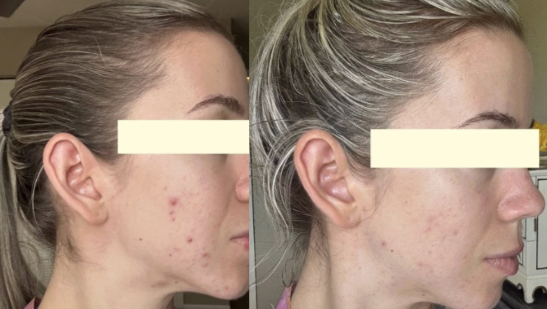 Root cause acne specialist and naturopathic doctor offering virtual 1:1 sessions and functional lab testing to uncover hormonal, gut, and lifestyle imbalances driving acne. Clear your skin from the inside out with personalized, holistic care.