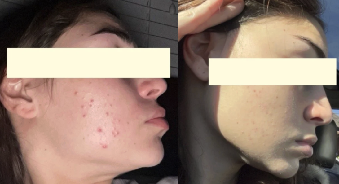 Root cause acne specialist and naturopathic doctor offering virtual 1:1 sessions and functional lab testing to uncover hormonal, gut, and lifestyle imbalances driving acne. Clear your skin from the inside out with personalized, holistic care.