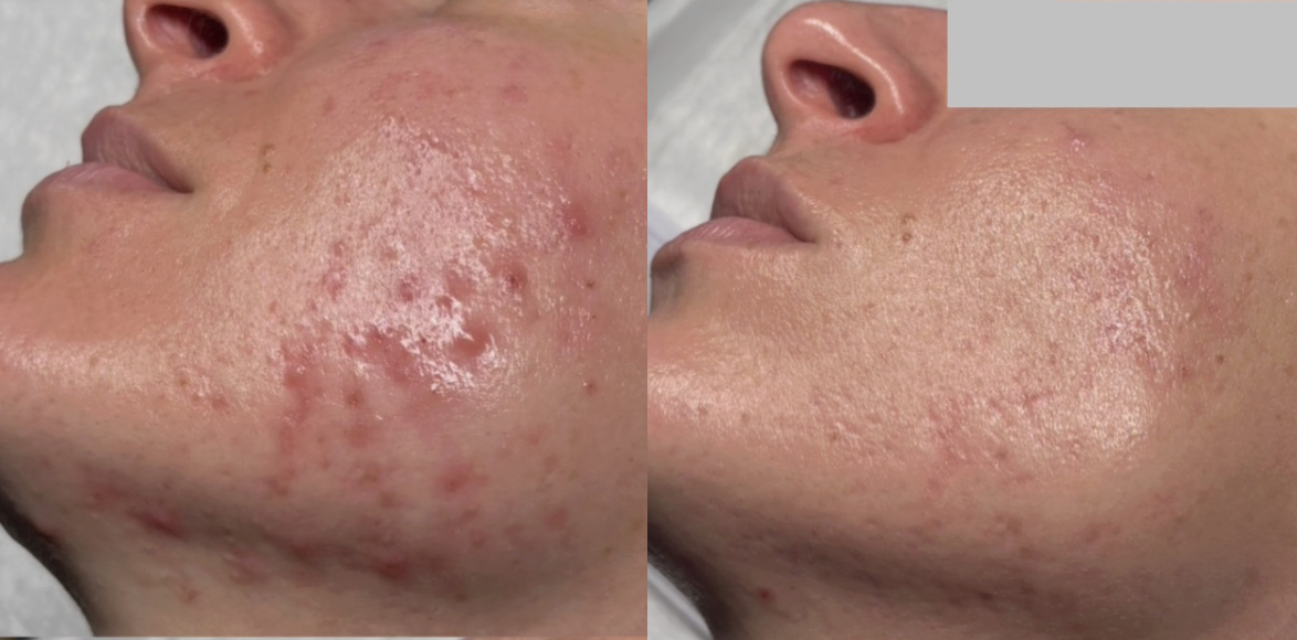 Root cause acne specialist and naturopathic doctor offering virtual 1:1 sessions and functional lab testing to uncover hormonal, gut, and lifestyle imbalances driving acne. Clear your skin from the inside out with personalized, holistic care.