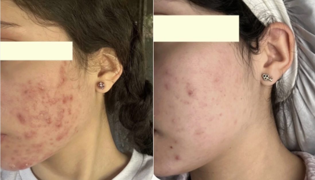 Root cause acne specialist and naturopathic doctor offering virtual 1:1 sessions and functional lab testing to uncover hormonal, gut, and lifestyle imbalances driving acne. Clear your skin from the inside out with personalized, holistic care.