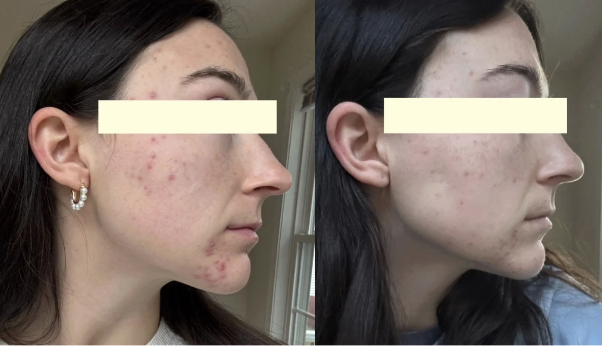 Root cause acne specialist and naturopathic doctor offering virtual 1:1 sessions and functional lab testing to uncover hormonal, gut, and lifestyle imbalances driving acne. Clear your skin from the inside out with personalized, holistic care.