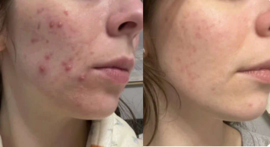 Root cause acne specialist and naturopathic doctor offering virtual 1:1 sessions and functional lab testing to uncover hormonal, gut, and lifestyle imbalances driving acne. Clear your skin from the inside out with personalized, holistic care.