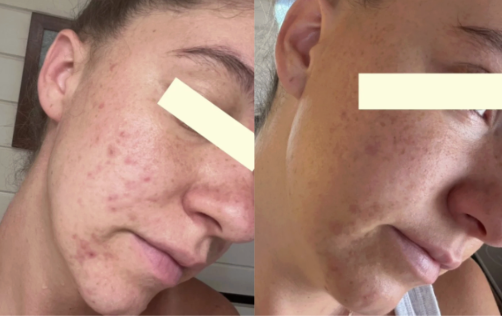 Root cause acne specialist and naturopathic doctor offering virtual 1:1 sessions and functional lab testing to uncover hormonal, gut, and lifestyle imbalances driving acne. Clear your skin from the inside out with personalized, holistic care.