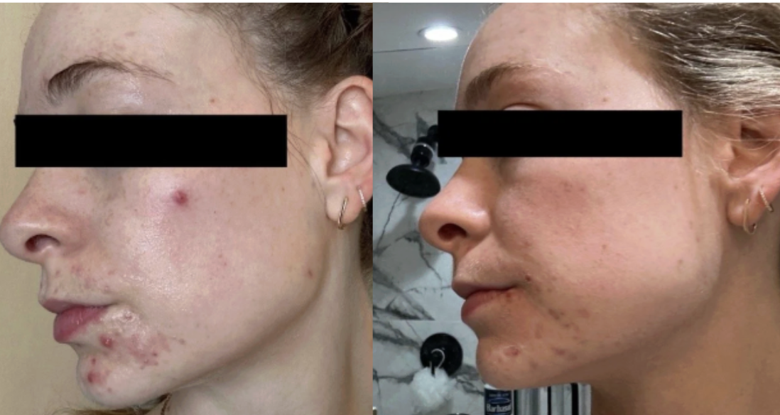 Side-by-side comparison of a woman with severe acne on the left and clearer skin after treatment on the right.