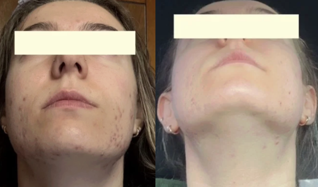 Root cause acne specialist and naturopathic doctor offering virtual 1:1 sessions and functional lab testing to uncover hormonal, gut, and lifestyle imbalances driving acne. Clear your skin from the inside out with personalized, holistic care.