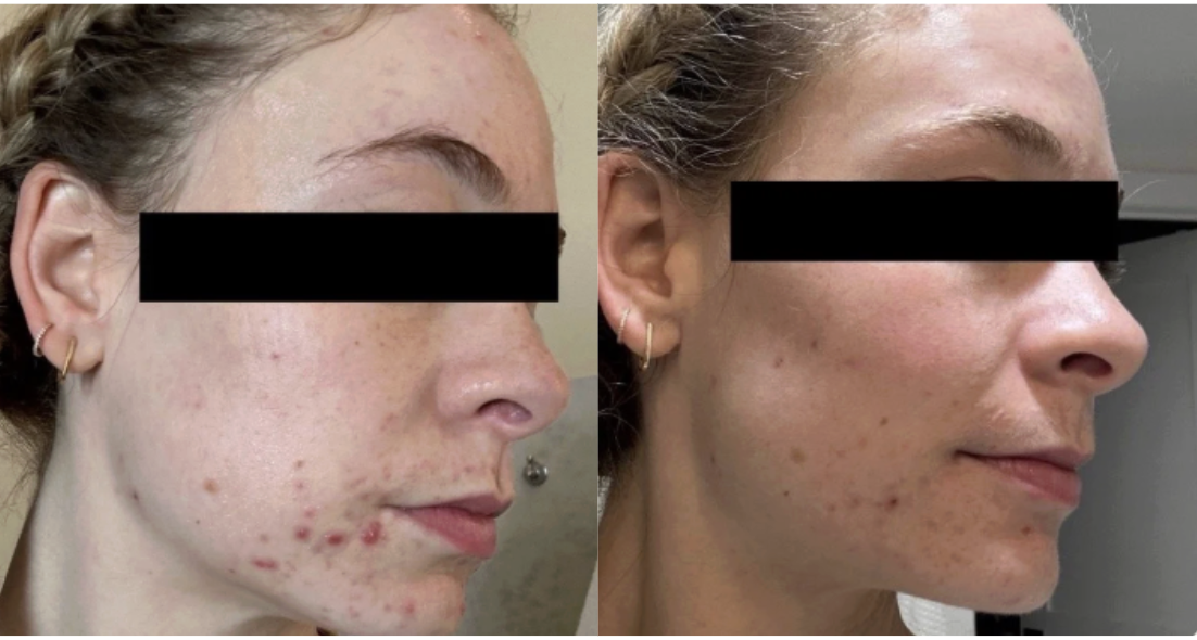 Root cause acne specialist and naturopathic doctor offering virtual 1:1 sessions and functional lab testing to uncover hormonal, gut, and lifestyle imbalances driving acne. Clear your skin from the inside out with personalized, holistic care.