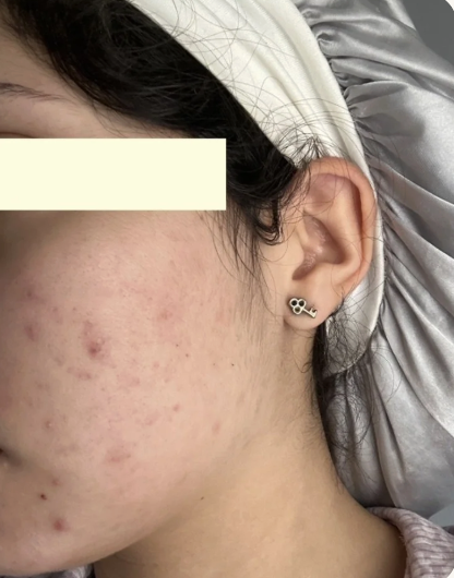 Close-up of a person's face showing acne on the cheek and ear, lying in a hospital bed.