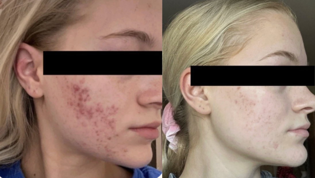Root cause acne specialist and naturopathic doctor offering virtual 1:1 sessions and functional lab testing to uncover hormonal, gut, and lifestyle imbalances driving acne. Clear your skin from the inside out with personalized, holistic care.