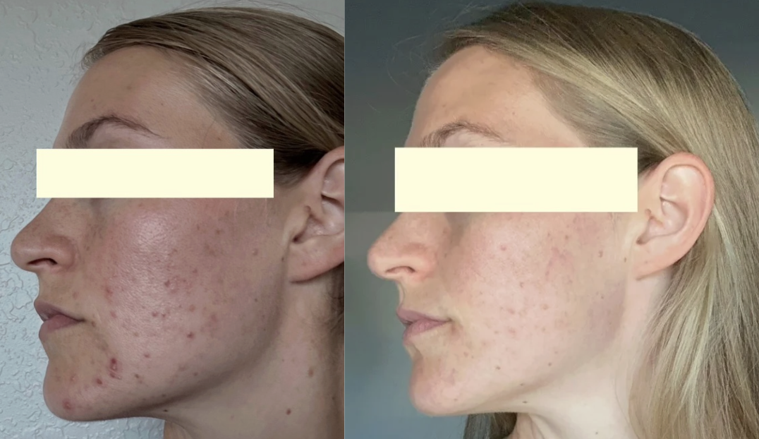 Root cause acne specialist and naturopathic doctor offering virtual 1:1 sessions and functional lab testing to uncover hormonal, gut, and lifestyle imbalances driving acne. Clear your skin from the inside out with personalized, holistic care.