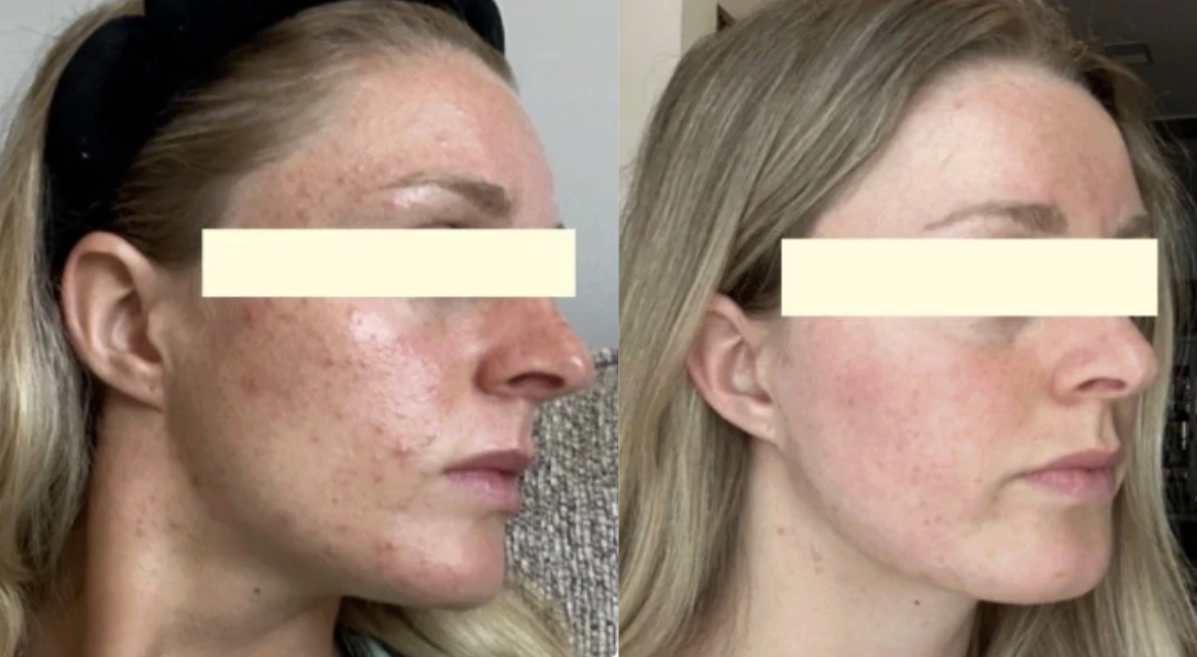 Root cause acne specialist and naturopathic doctor offering virtual 1:1 sessions and functional lab testing to uncover hormonal, gut, and lifestyle imbalances driving acne. Clear your skin from the inside out with personalized, holistic care.