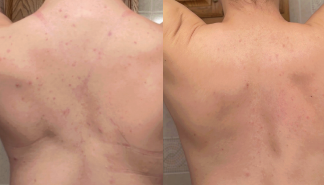 Root cause acne specialist and naturopathic doctor offering virtual 1:1 sessions and functional lab testing to uncover hormonal, gut, and lifestyle imbalances driving acne. Clear your skin from the inside out with personalized, holistic care.