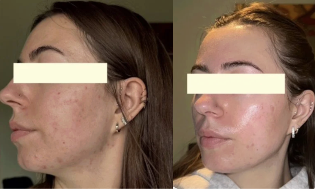 Root cause acne specialist and naturopathic doctor offering virtual 1:1 sessions and functional lab testing to uncover hormonal, gut, and lifestyle imbalances driving acne. Clear your skin from the inside out with personalized, holistic care.