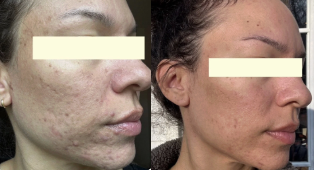 Root cause acne specialist and naturopathic doctor offering virtual 1:1 sessions and functional lab testing to uncover hormonal, gut, and lifestyle imbalances driving acne. Clear your skin from the inside out with personalized, holistic care.