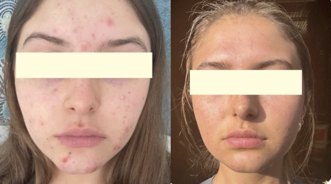 Root cause acne specialist and naturopathic doctor offering virtual 1:1 sessions and functional lab testing to uncover hormonal, gut, and lifestyle imbalances driving acne. Clear your skin from the inside out with personalized, holistic care.