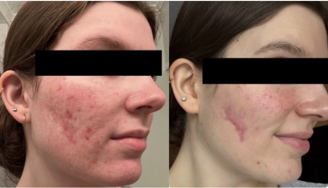 Root cause acne specialist and naturopathic doctor offering virtual 1:1 sessions and functional lab testing to uncover hormonal, gut, and lifestyle imbalances driving acne. Clear your skin from the inside out with personalized, holistic care.