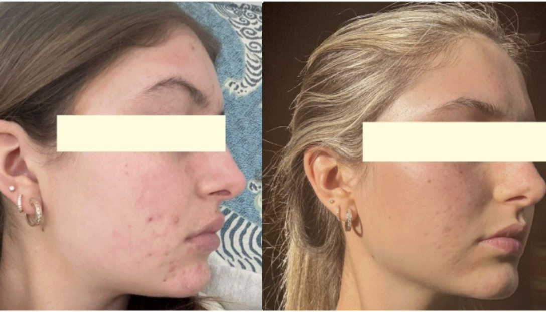 Root cause acne specialist and naturopathic doctor offering virtual 1:1 sessions and functional lab testing to uncover hormonal, gut, and lifestyle imbalances driving acne. Clear your skin from the inside out with personalized, holistic care.