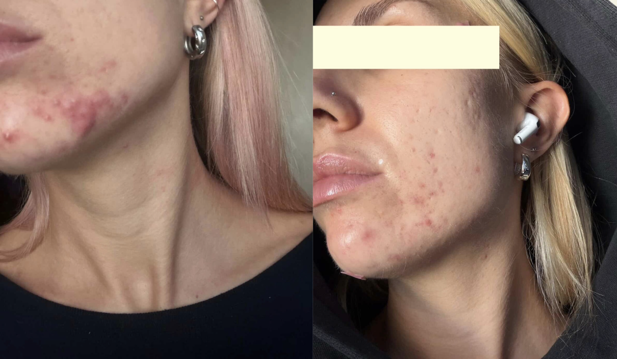 Root cause acne specialist and naturopathic doctor offering virtual 1:1 sessions and functional lab testing to uncover hormonal, gut, and lifestyle imbalances driving acne. Clear your skin from the inside out with personalized, holistic care.