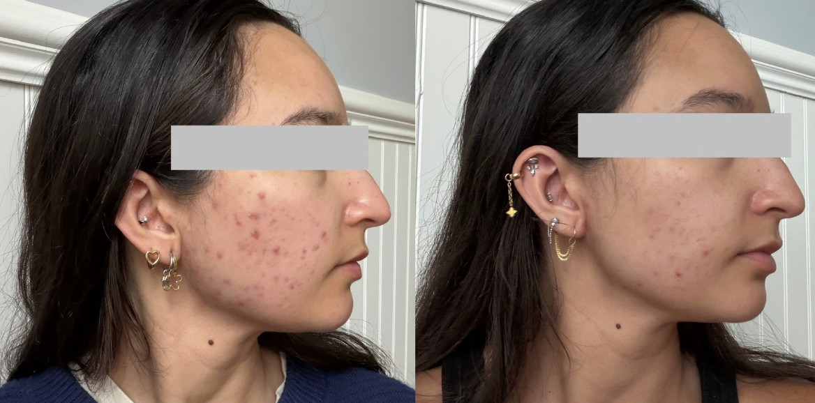 Root cause acne specialist and naturopathic doctor offering virtual 1:1 sessions and functional lab testing to uncover hormonal, gut, and lifestyle imbalances driving acne. Clear your skin from the inside out with personalized, holistic care.