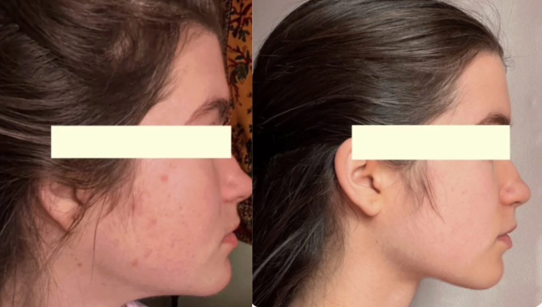 Root cause acne specialist and naturopathic doctor offering virtual 1:1 sessions and functional lab testing to uncover hormonal, gut, and lifestyle imbalances driving acne. Clear your skin from the inside out with personalized, holistic care.