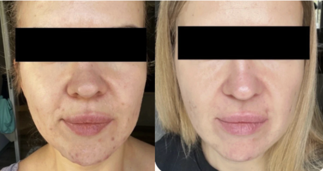 Root cause acne specialist and naturopathic doctor offering virtual 1:1 sessions and functional lab testing to uncover hormonal, gut, and lifestyle imbalances driving acne. Clear your skin from the inside out with personalized, holistic care.