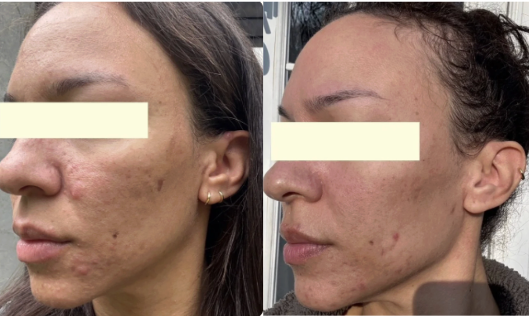 Root cause acne specialist and naturopathic doctor offering virtual 1:1 sessions and functional lab testing to uncover hormonal, gut, and lifestyle imbalances driving acne. Clear your skin from the inside out with personalized, holistic care.
