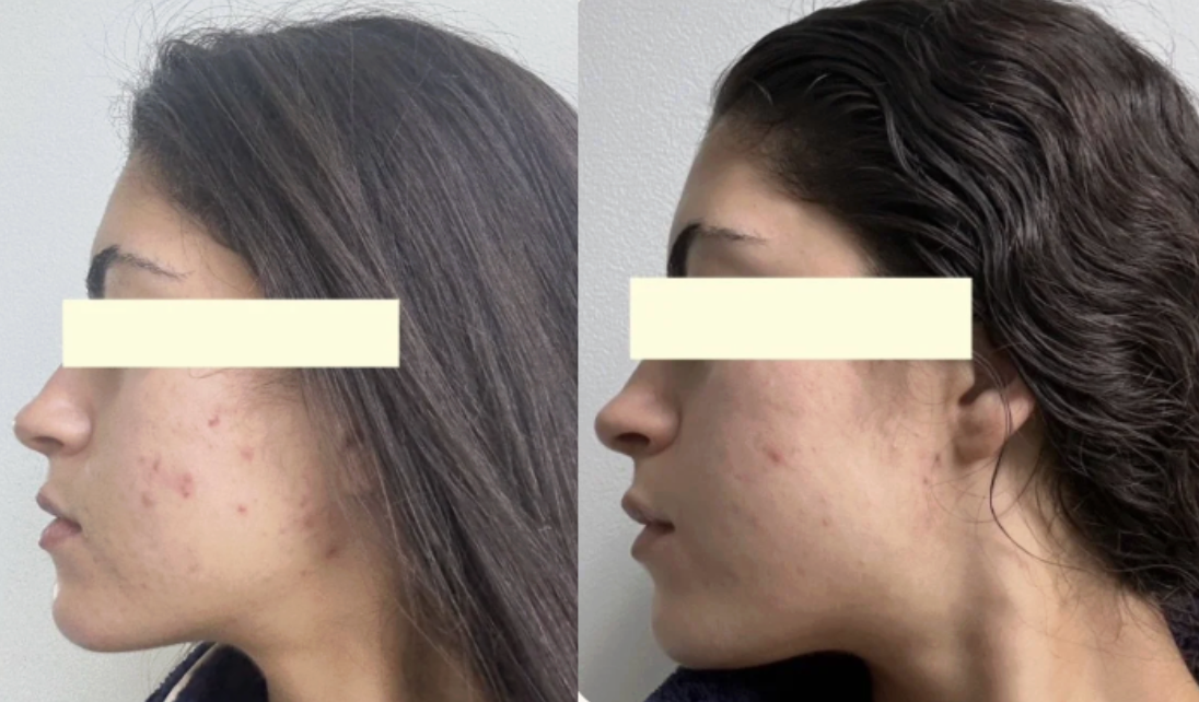 Root cause acne specialist and naturopathic doctor offering virtual 1:1 sessions and functional lab testing to uncover hormonal, gut, and lifestyle imbalances driving acne. Clear your skin from the inside out with personalized, holistic care.