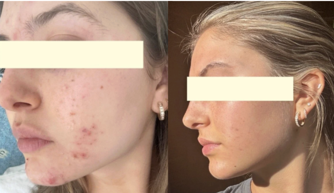 Root cause acne specialist and naturopathic doctor offering virtual 1:1 sessions and functional lab testing to uncover hormonal, gut, and lifestyle imbalances driving acne. Clear your skin from the inside out with personalized, holistic care.
