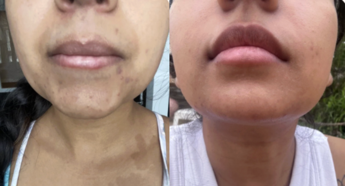 Root cause acne specialist and naturopathic doctor offering virtual 1:1 sessions and functional lab testing to uncover hormonal, gut, and lifestyle imbalances driving acne. Clear your skin from the inside out with personalized, holistic care.