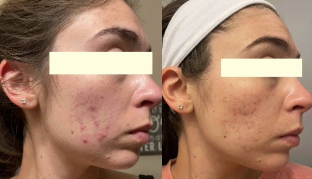Root cause acne specialist and naturopathic doctor offering virtual 1:1 sessions and functional lab testing to uncover hormonal, gut, and lifestyle imbalances driving acne. Clear your skin from the inside out with personalized, holistic care.