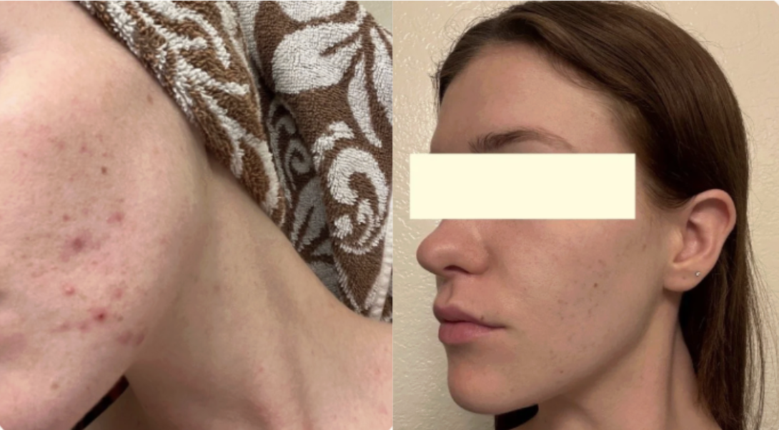 Root cause acne specialist and naturopathic doctor offering virtual 1:1 sessions and functional lab testing to uncover hormonal, gut, and lifestyle imbalances driving acne. Clear your skin from the inside out with personalized, holistic care.