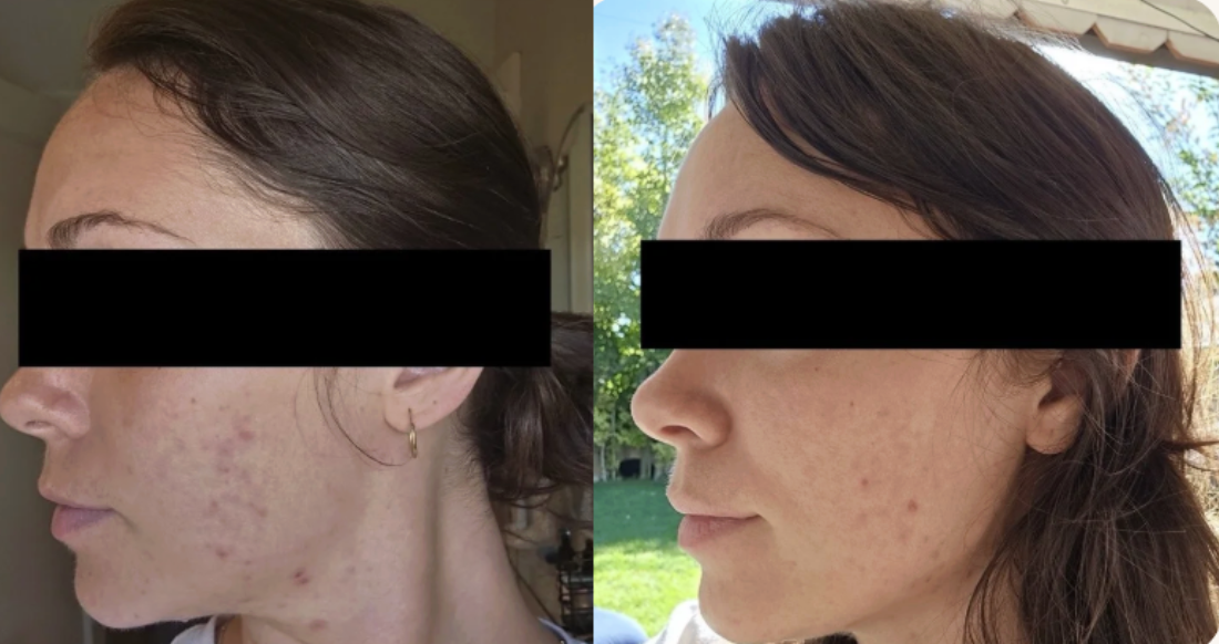 Root cause acne specialist and naturopathic doctor offering virtual 1:1 sessions and functional lab testing to uncover hormonal, gut, and lifestyle imbalances driving acne. Clear your skin from the inside out with personalized, holistic care.