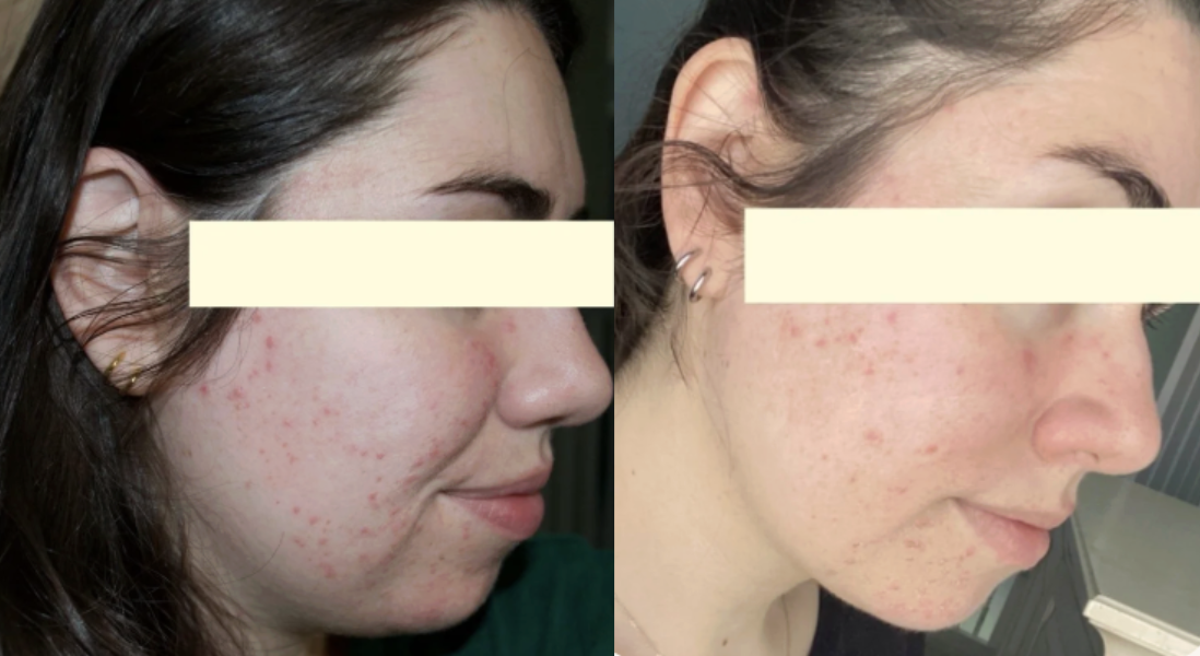 Root cause acne specialist and naturopathic doctor offering virtual 1:1 sessions and functional lab testing to uncover hormonal, gut, and lifestyle imbalances driving acne. Clear your skin from the inside out with personalized, holistic care.