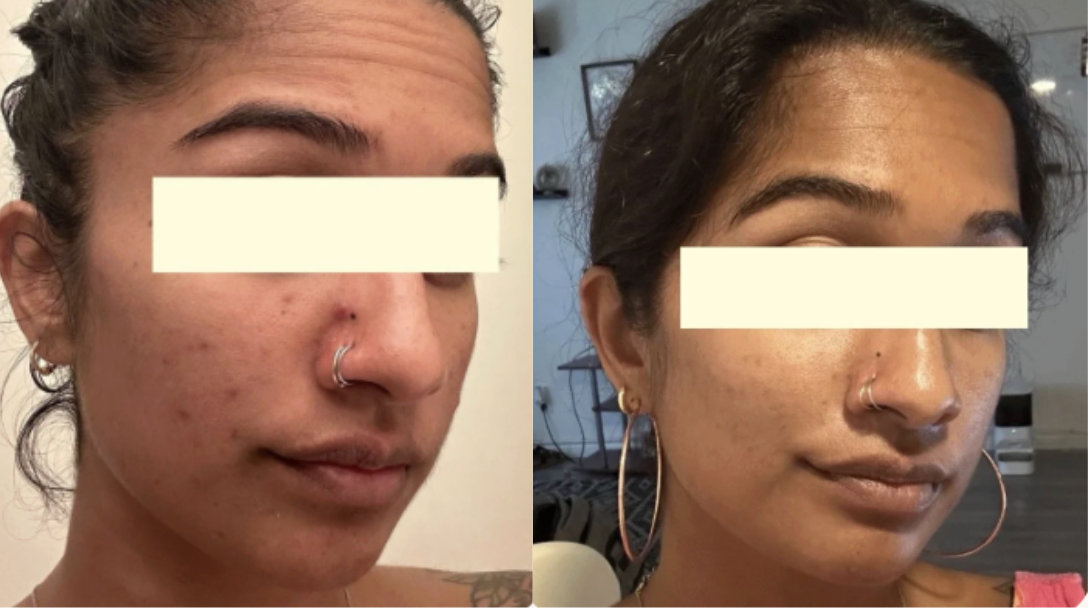 Root cause acne specialist and naturopathic doctor offering virtual 1:1 sessions and functional lab testing to uncover hormonal, gut, and lifestyle imbalances driving acne. Clear your skin from the inside out with personalized, holistic care.