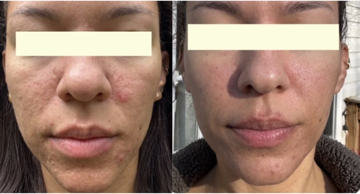 Root cause acne specialist and naturopathic doctor offering virtual 1:1 sessions and functional lab testing to uncover hormonal, gut, and lifestyle imbalances driving acne. Clear your skin from the inside out with personalized, holistic care.