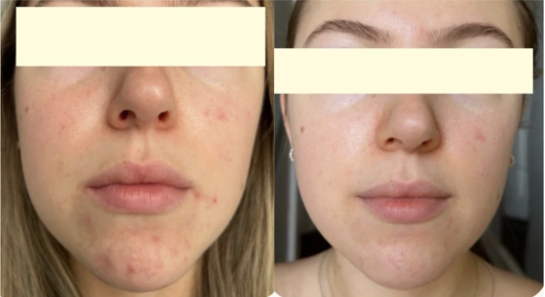 Root cause acne specialist and naturopathic doctor offering virtual 1:1 sessions and functional lab testing to uncover hormonal, gut, and lifestyle imbalances driving acne. Clear your skin from the inside out with personalized, holistic care.