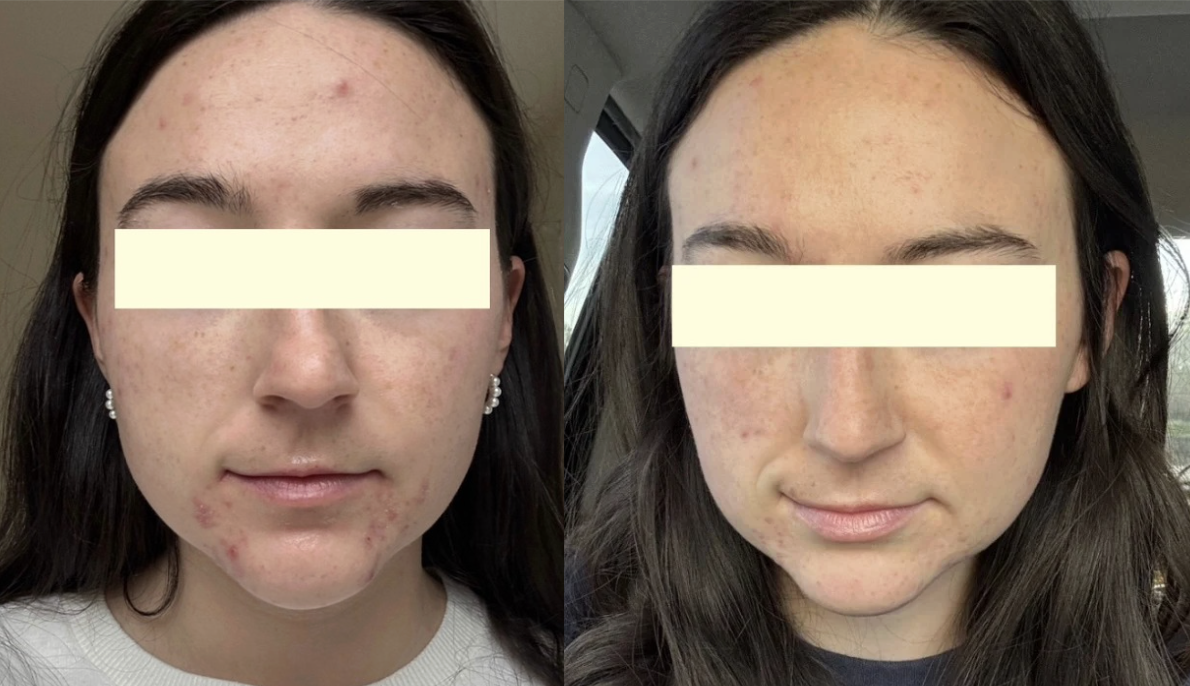 Root cause acne specialist and naturopathic doctor offering virtual 1:1 sessions and functional lab testing to uncover hormonal, gut, and lifestyle imbalances driving acne. Clear your skin from the inside out with personalized, holistic care.