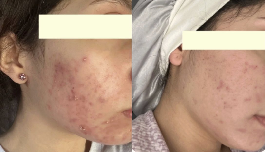 Root cause acne specialist and naturopathic doctor offering virtual 1:1 sessions and functional lab testing to uncover hormonal, gut, and lifestyle imbalances driving acne. Clear your skin from the inside out with personalized, holistic care.