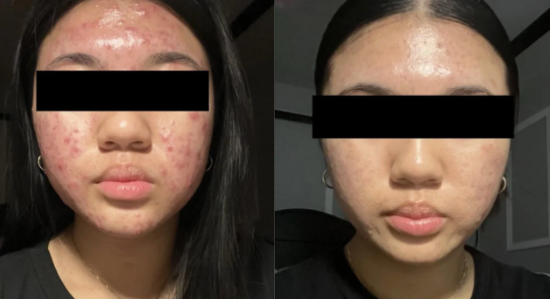Root cause acne specialist and naturopathic doctor offering virtual 1:1 sessions and functional lab testing to uncover hormonal, gut, and lifestyle imbalances driving acne. Clear your skin from the inside out with personalized, holistic care.