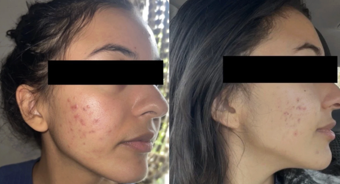 Root cause acne specialist and naturopathic doctor offering virtual 1:1 sessions and functional lab testing to uncover hormonal, gut, and lifestyle imbalances driving acne. Clear your skin from the inside out with personalized, holistic care.